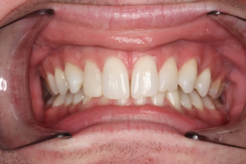Upper Teeth Gap Before After - Full upper/lower arch teeth