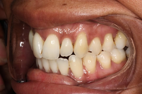 Crowded Teeth Before After - Left upper front teeth 