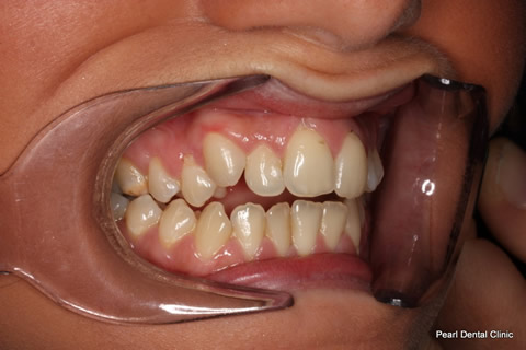Tooth Crowding Before After - Right full arch upper/lower teeth