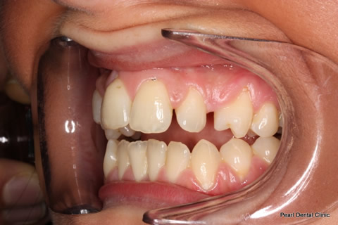 Tooth Crowding Before After - Left full arch upper/lower teeth