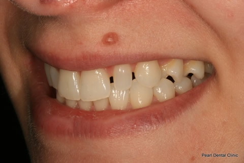 Teeth Gap Before After - Left upper/lower teeth