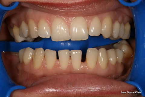Teeth Gap Before After - Upper/lower teeth