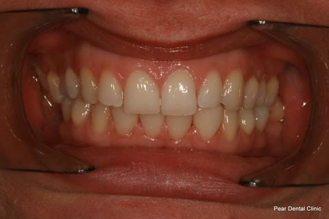Teeth Gap Before After - Upper/lower teeth lumineers