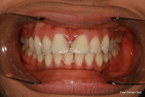 Front Teeth Gap Before After - Upper/lower Teeth