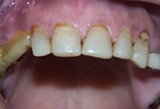 Mouth Rehabilitation Before After - Top arch worn teeth