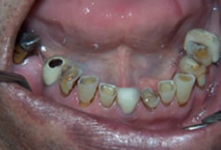 Mouth Rehabilitation Before After - Bottom arch missing/worn teeth