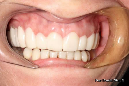 Snap-on Smile Before After - Full upper/lower arches teeth