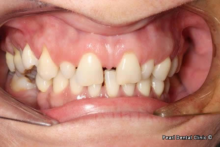 Snap-on Smile Before After - Full upper/lower arches right side teeth