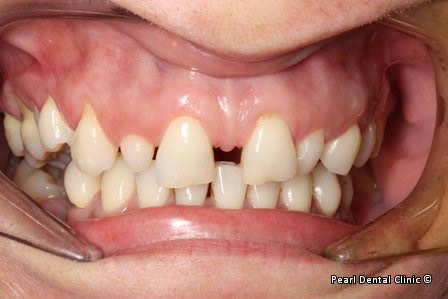 Snap-on Smile Before After - Full upper/lower arches right side teeth