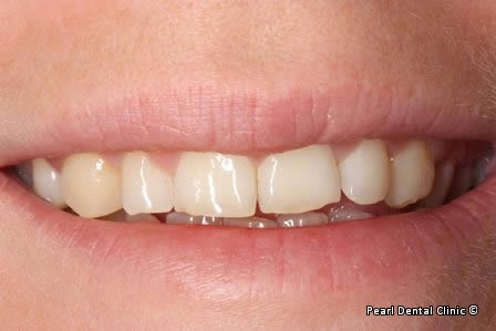 Snap-on Smile Before After - Full smile