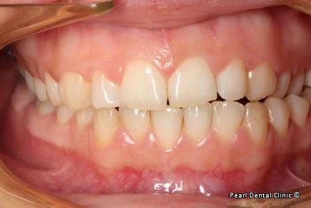 Snap-on Smile Before After - Full upper/lower arches teeth