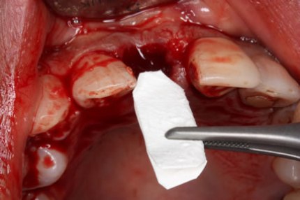 Soft Tissues Grafting Before After - Porcine derived Bio-Gide membrane outside gum