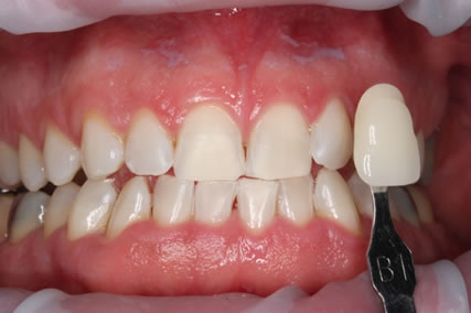 Teeth Whitening Before After - Teeth zoom whitening
