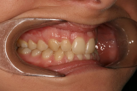Front Teeth Appearance Before After - Right full upper/lower arch teeth