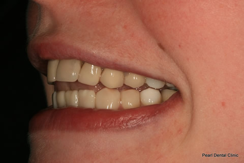 Lower Teeth Gap/ Discoloured Before After - Upper/lower composite veneers