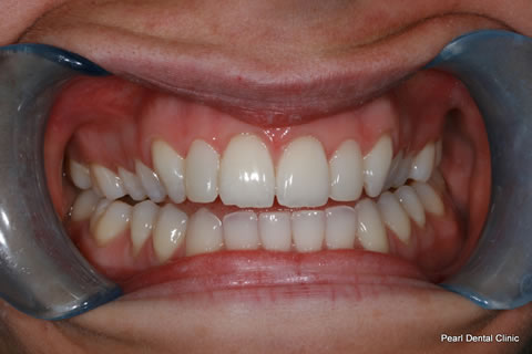 Upper Front Teeth Before After - Upper teeth composite veneers
