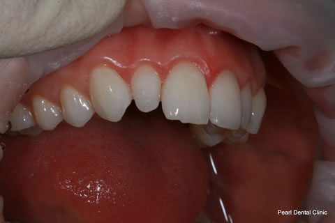 Composite Bonding Before After - Upper teeth
