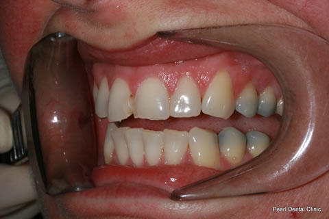 Composite Bonding Before After - Left upper front teeth