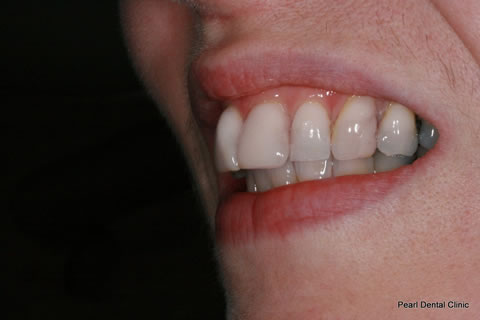 Composite Bonding Before After - Left upper front teeth composite bonding