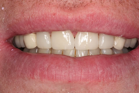 Composite Bonding Before After - Front composite teeth bonding