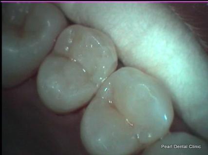 Before After Mercury Free White Fillings - Replaced fillings 