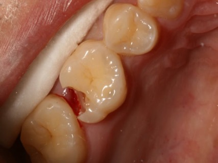 Before After Mercury Free White Fillings - Replacing fillings 