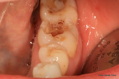 Before After Mercury Free White Fillings - Mercury free fillings 
