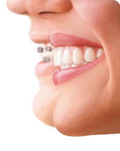 Invisible Braces