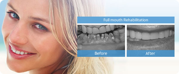 Full Mouth Rehabilitation