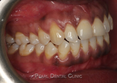 AM_Invisalign_buccal_right after