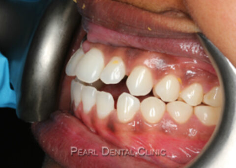 AN_Invisalign_buccal_left before
