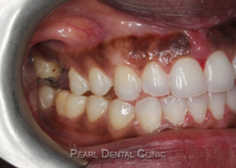 AN_Invisalign_buccal_right after