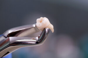 cost of tooth extraction