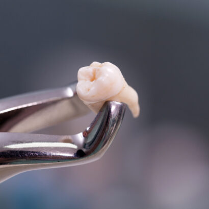 Cost of Tooth Extraction