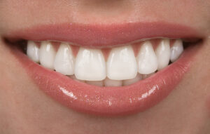 How To Make Your Teeth Straight Without Braces