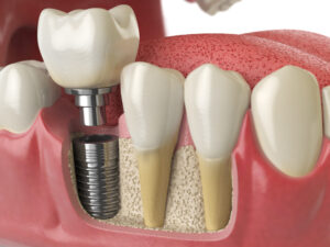 dental implantation