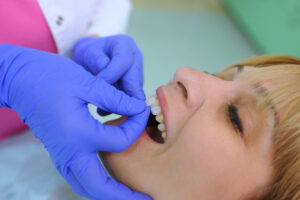 veneers on finance