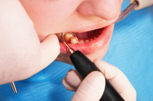 Gum Disease Specialist London
