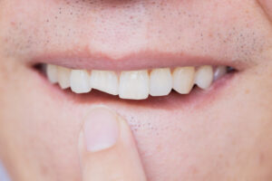cracked tooth repair