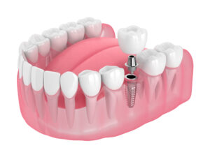 Tooth Implant Cost UK