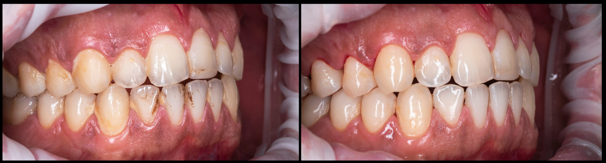 Airflow Teeth Cleaning in London Dental Hygiene 7 days a week