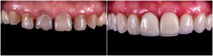 veneers on finance