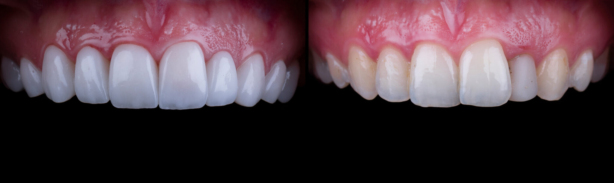 Emax Veneers & Porcelain Dental Veneers in Kingston, London.