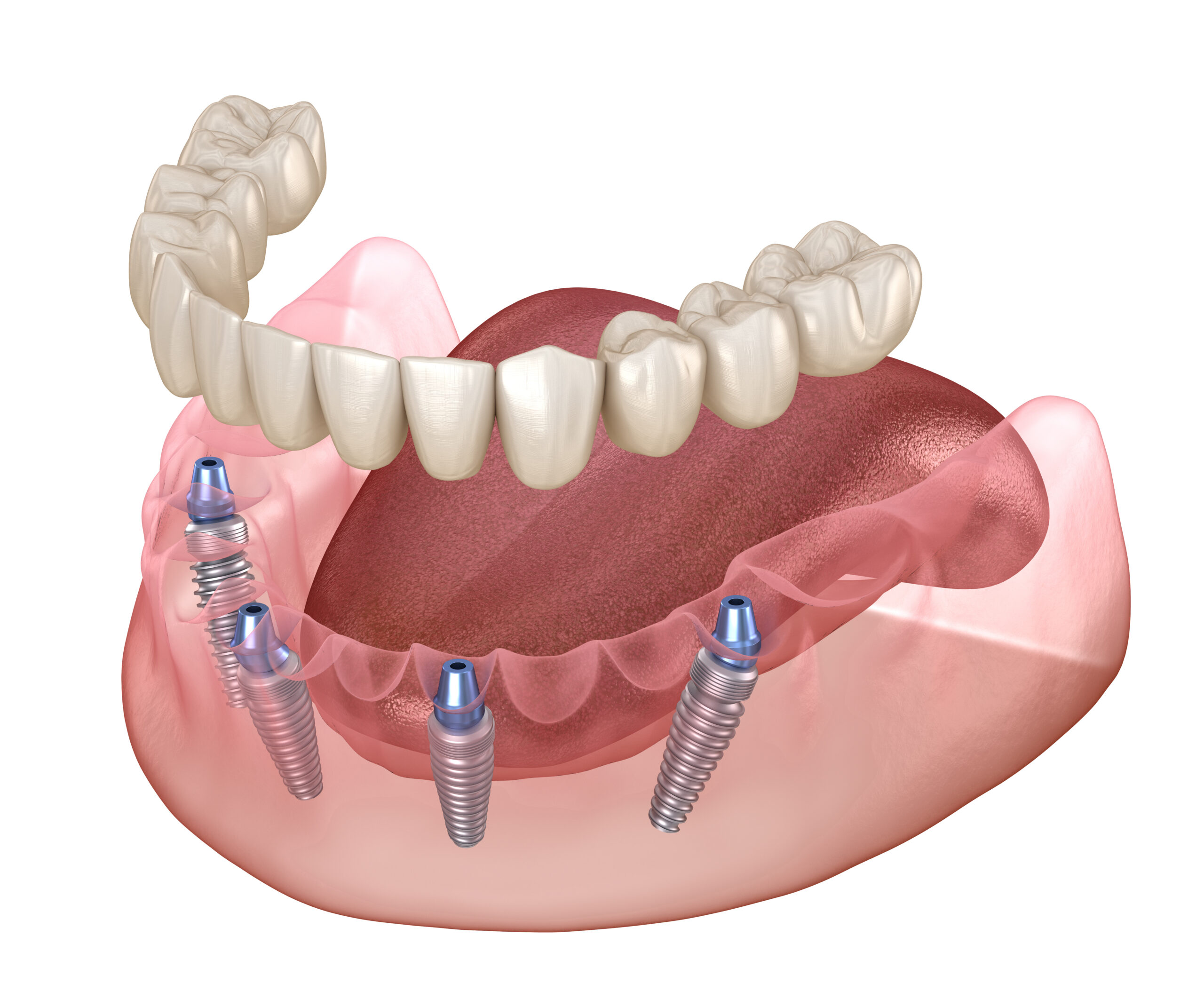 All On 4 Dental Implants Pearl Dental Clinic Kingston, London.