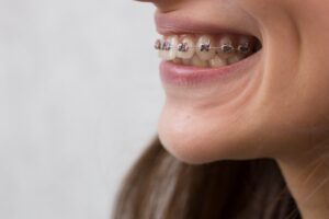 metal braces