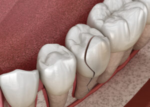 cracked tooth repair