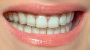 invisible braces