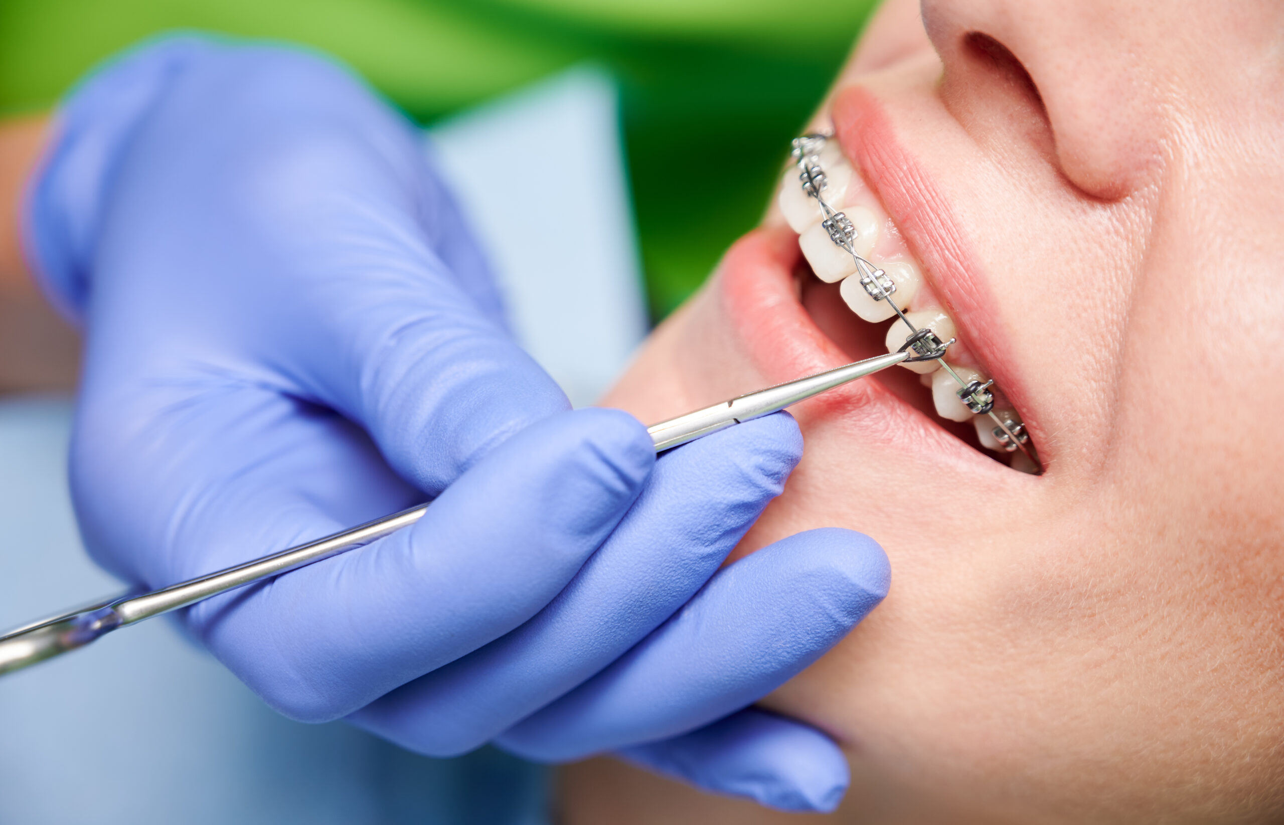 Braces Fixed Invisible Pearl Dental Clinic SW15