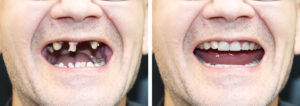 how much to remove a tooth