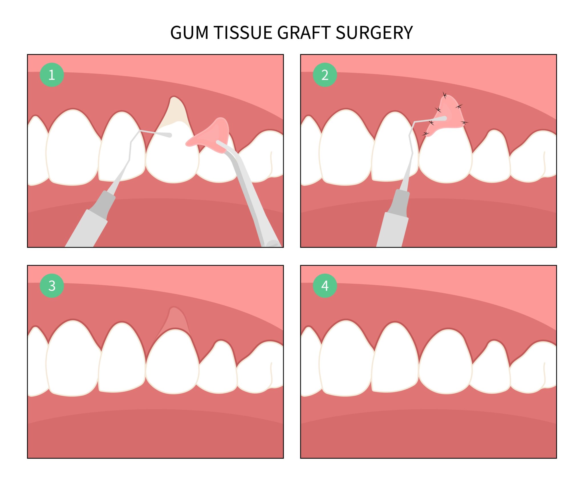Gum Graft Surgery Dentist Kingston